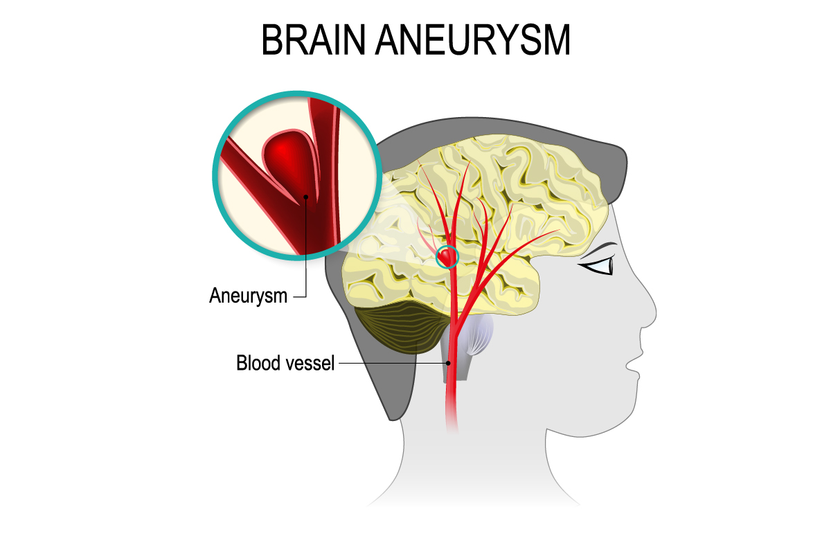 Graphic showing a closeup of an aneurysm in a patients brain. It shows the blood vessel and where the aneurysm occurred.