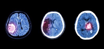 Showing an Example of Brain Tumors