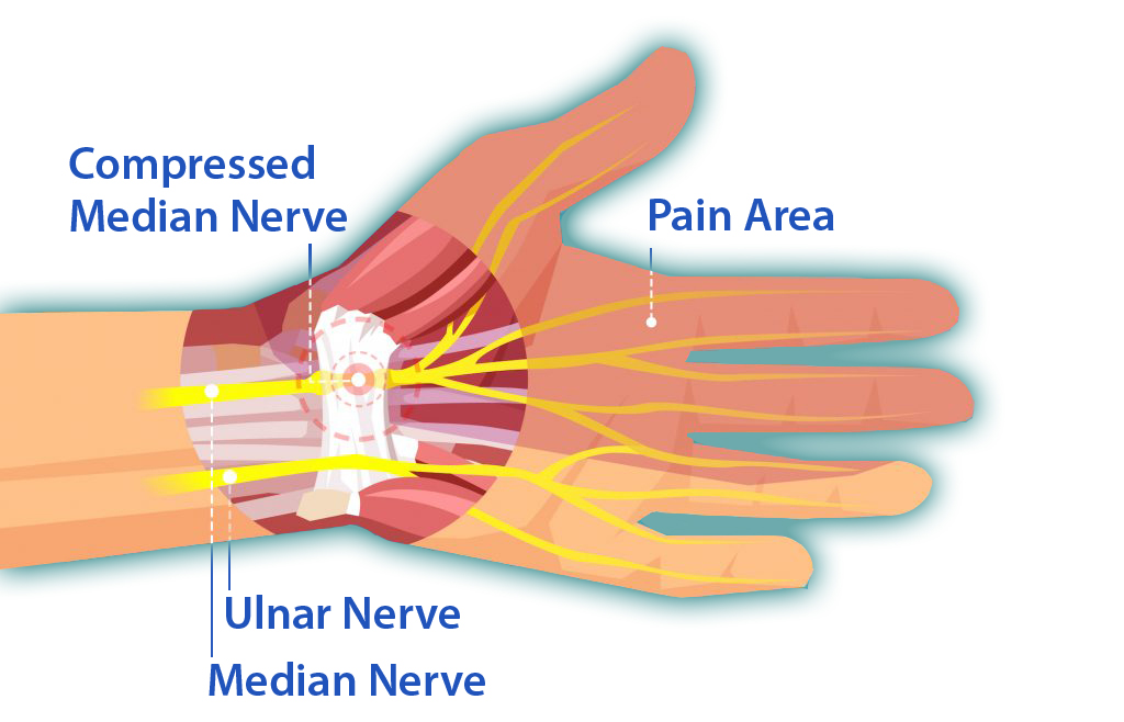 How To Know If You Have Carpal Tunnel Syndrome?