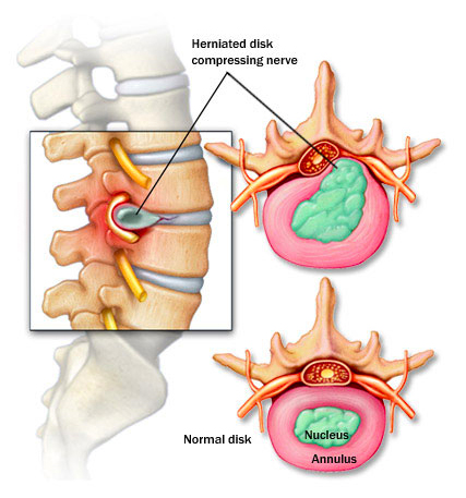 Graphic of a Herniated Disk